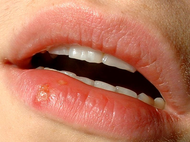How to get rid of cold sores fast?