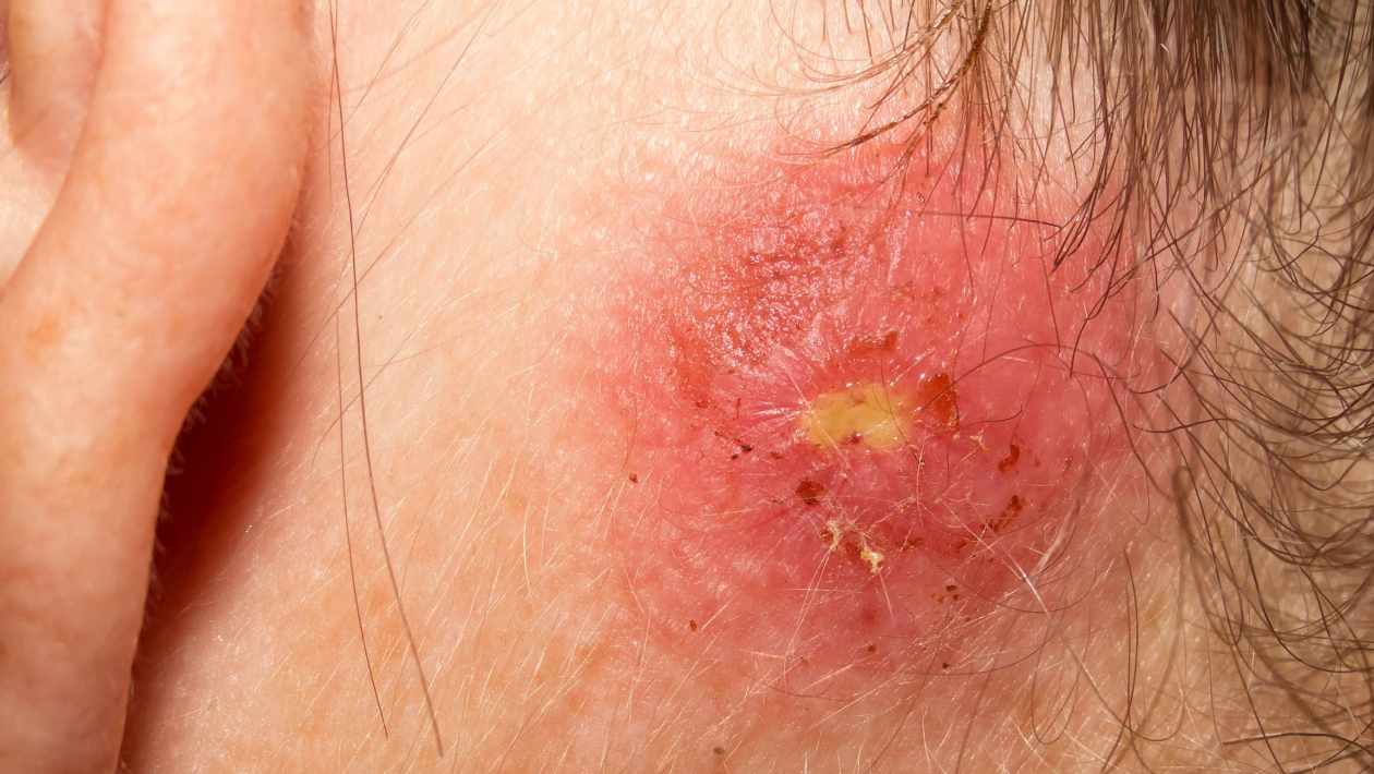 Staph Infection On Skin 1260x710 
