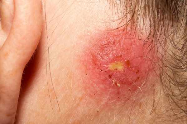 Staph Infection on Skin