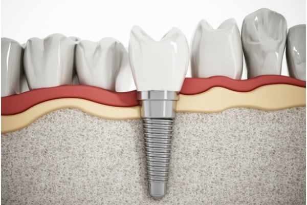 How Much are Dental Implants