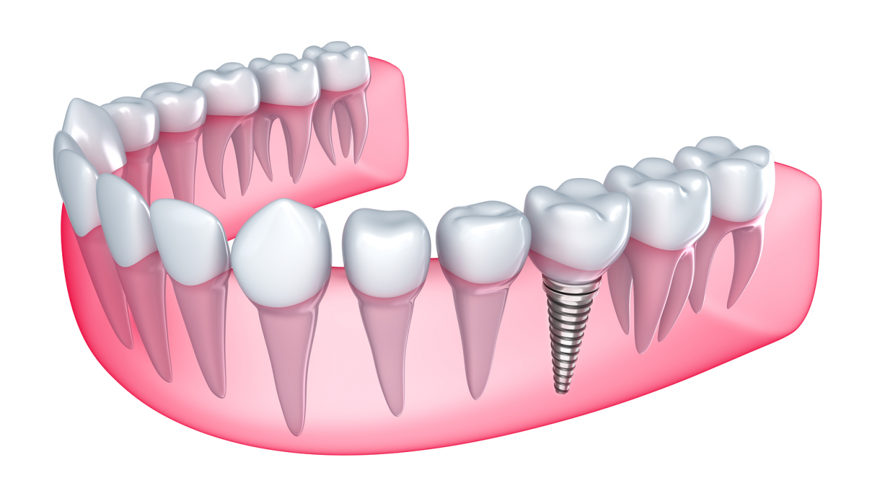 What Implant Retained Dentures