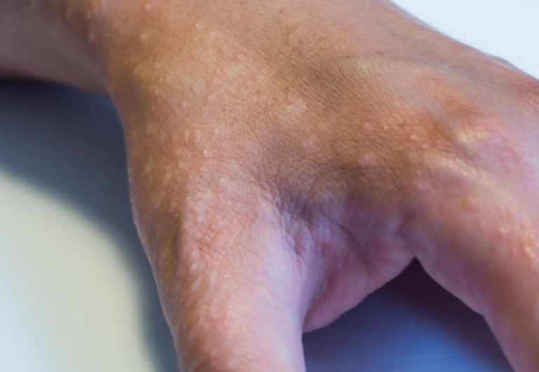 Dyshidrotic Eczema On Hand 768x531 