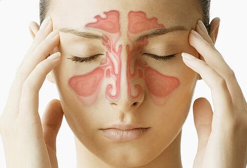 Are sinus infections contagious