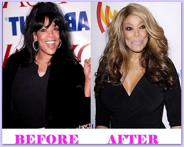 Was Wendy Williams Before Surgery and After Surgery Photo Truth or Rumor