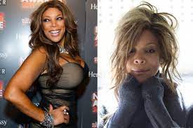 wendy williams before surgery