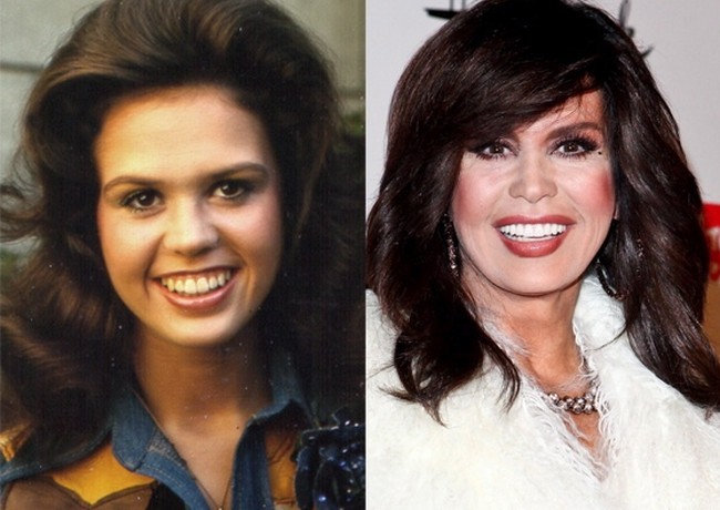Marie Osmond Plastic Surgery On The Scale Of Truth