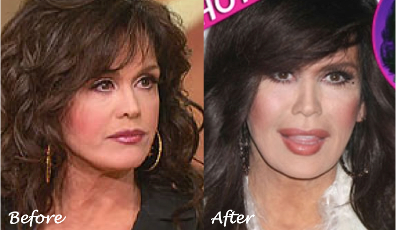 Marie Osmond Plastic Surgery Although many stars have gone under the knife ...