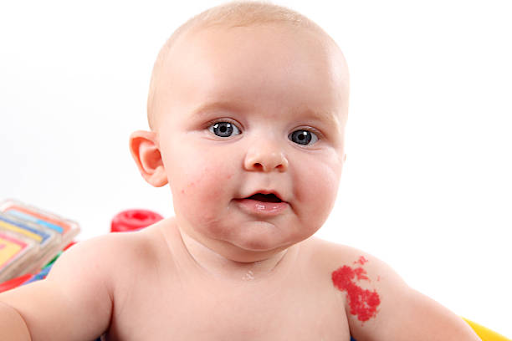 Birthmarks in Babies