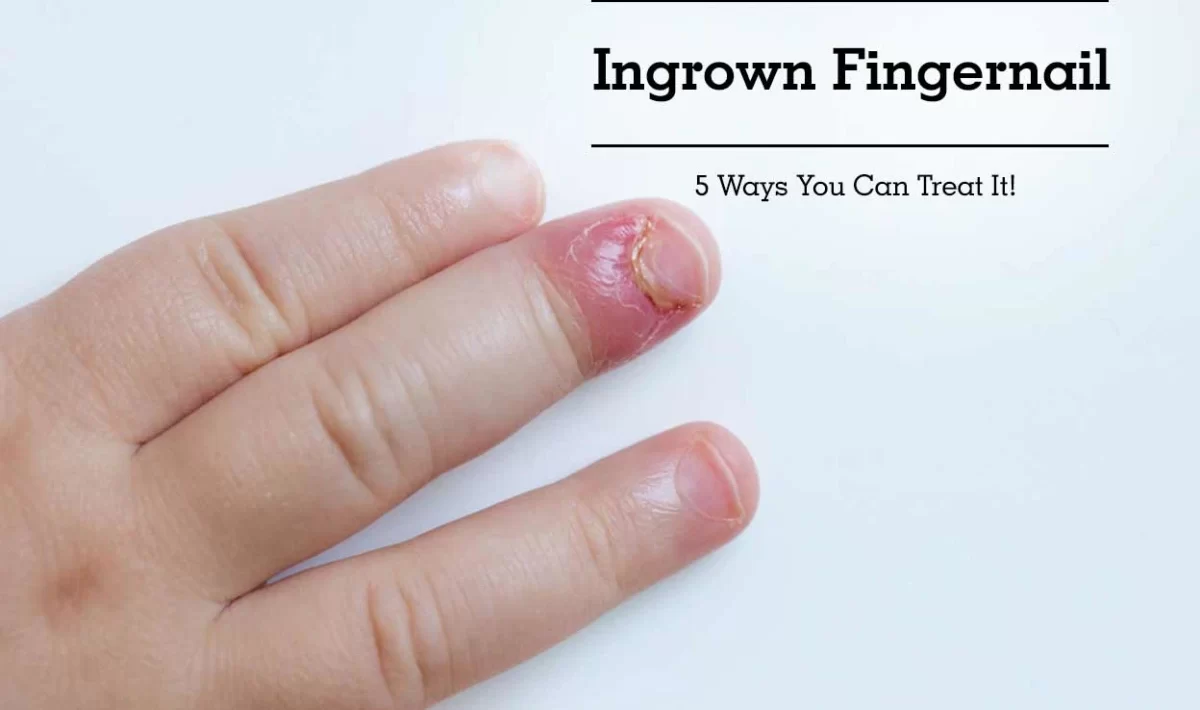 Ingrown Fingernail