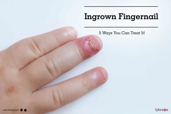 Ingrown Fingernail