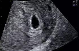 What are the results of the 7th-week ultrasound