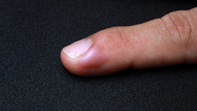 What is an ingrown fingernail