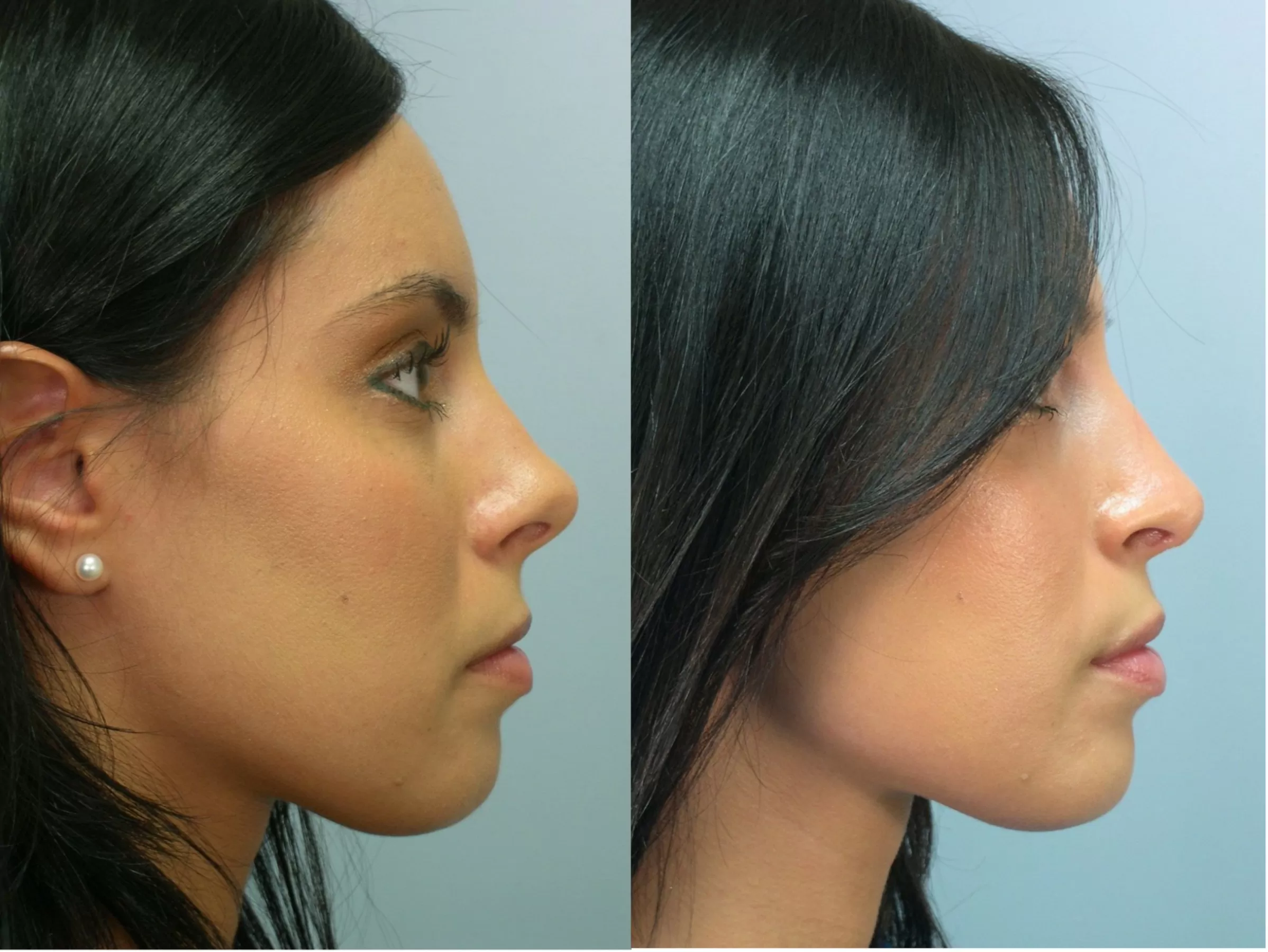 Does medical insurance cover the rhinoplasty procedure