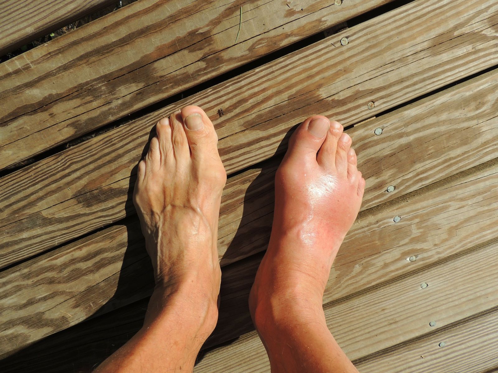 What symptoms indicate gout in the ankle?