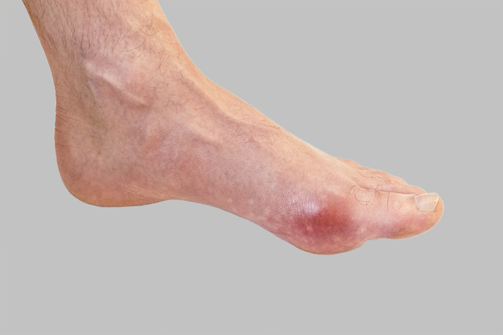 Gout in Ankle