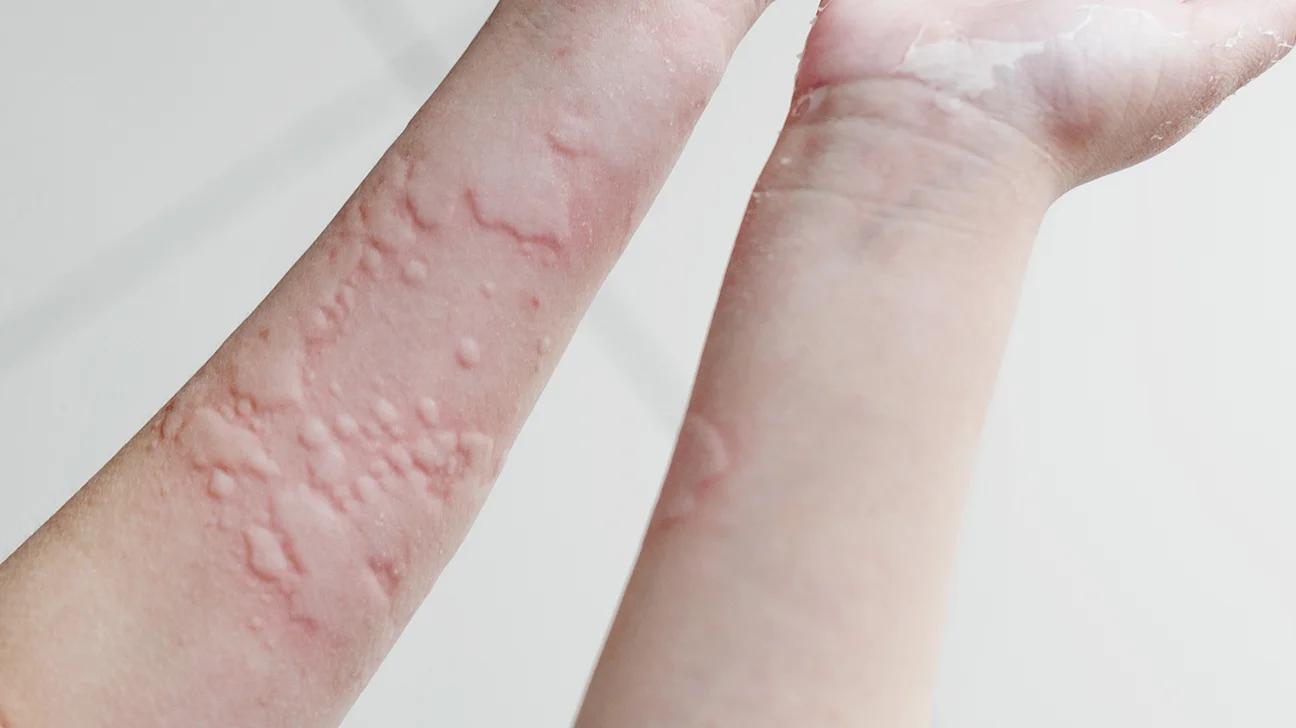 A look at the scabies rash