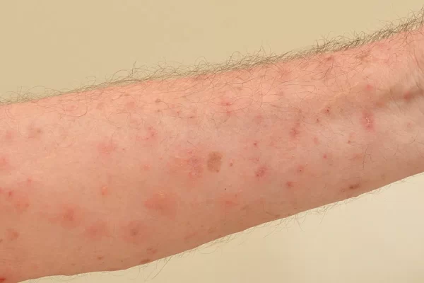 What Can Be Mistaken For Scabies
